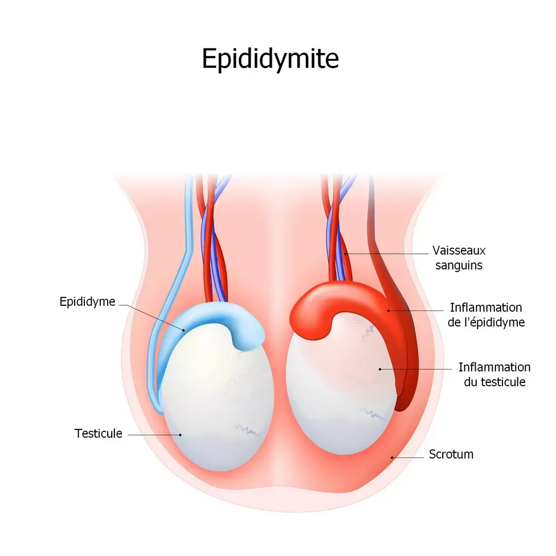 Kystes de l epididyme