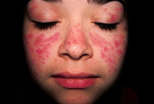 Combatir el lupus eritematoso con plantas medicinales