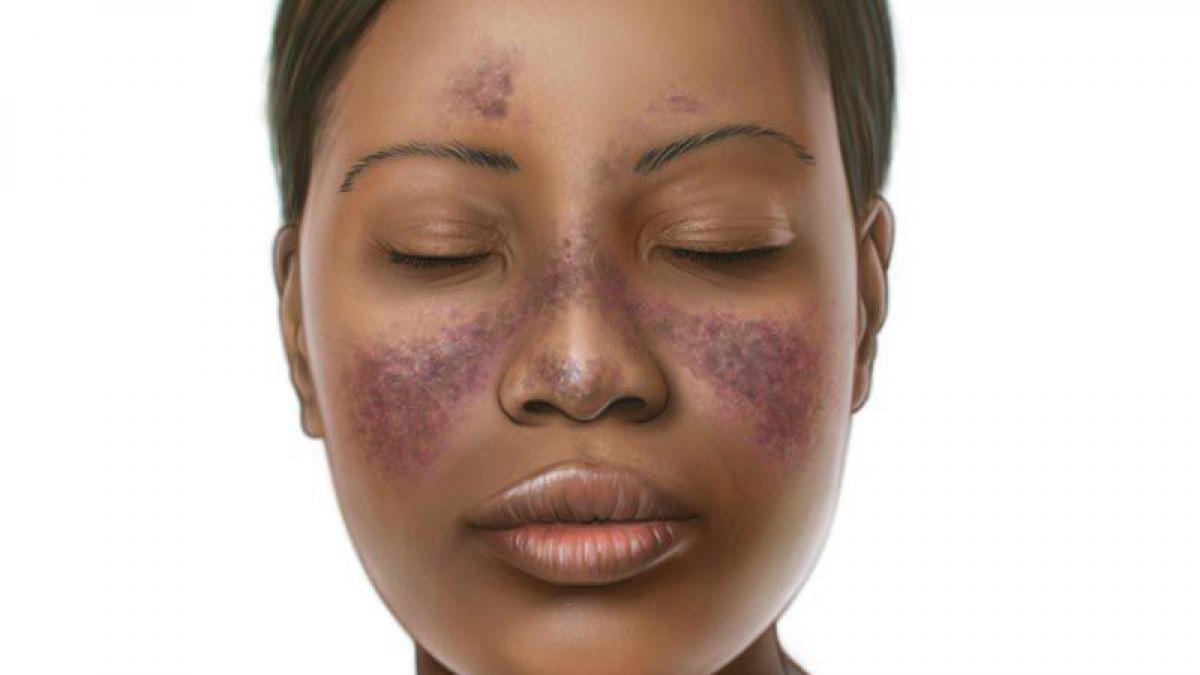 Lupus 2