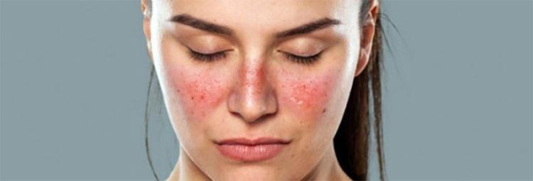 MOYENS NATURELS DE LUTTE CONTRE LE LUPUS