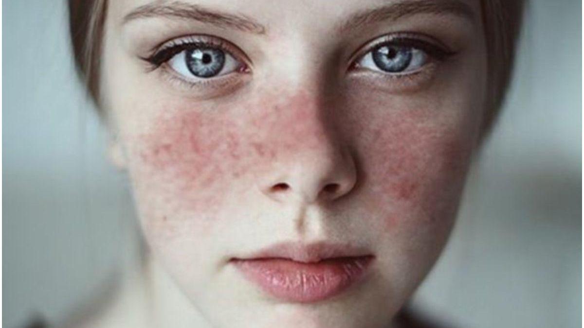 Guérir le lupus avec les plantes
