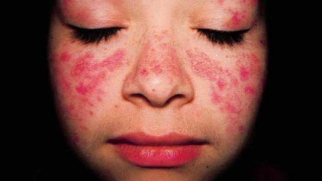 Plantes et remèdes naturels contre le lupus