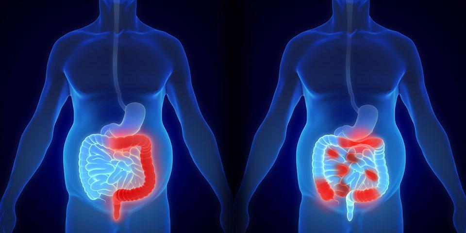 Plantes contre la maladie de Crohn