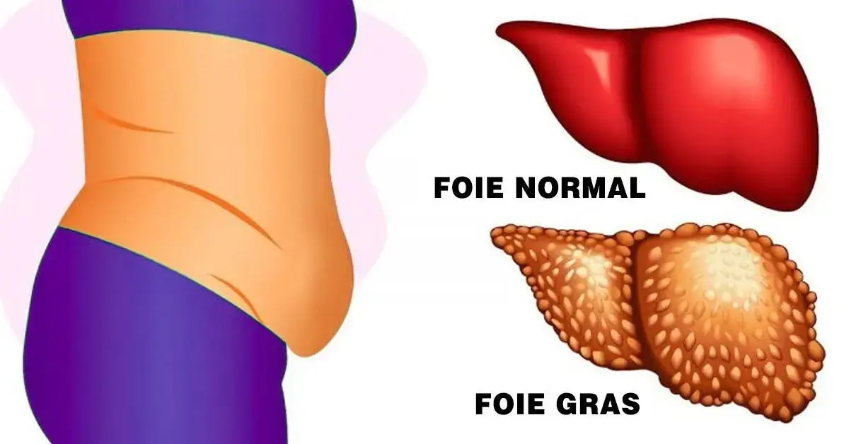 Maladie du foie gras