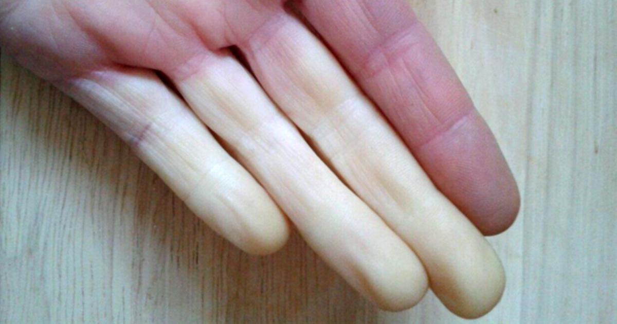 Phénomène de Raynaud et dermatomyosite : guérison naturelle