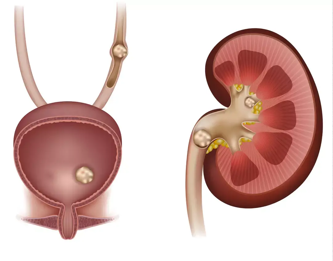 Microlithiase calculs urinaires 