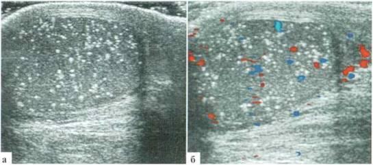 Microlithiase testiculaire