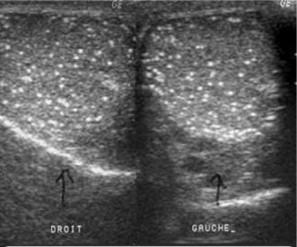 Microlithiase testiculaire