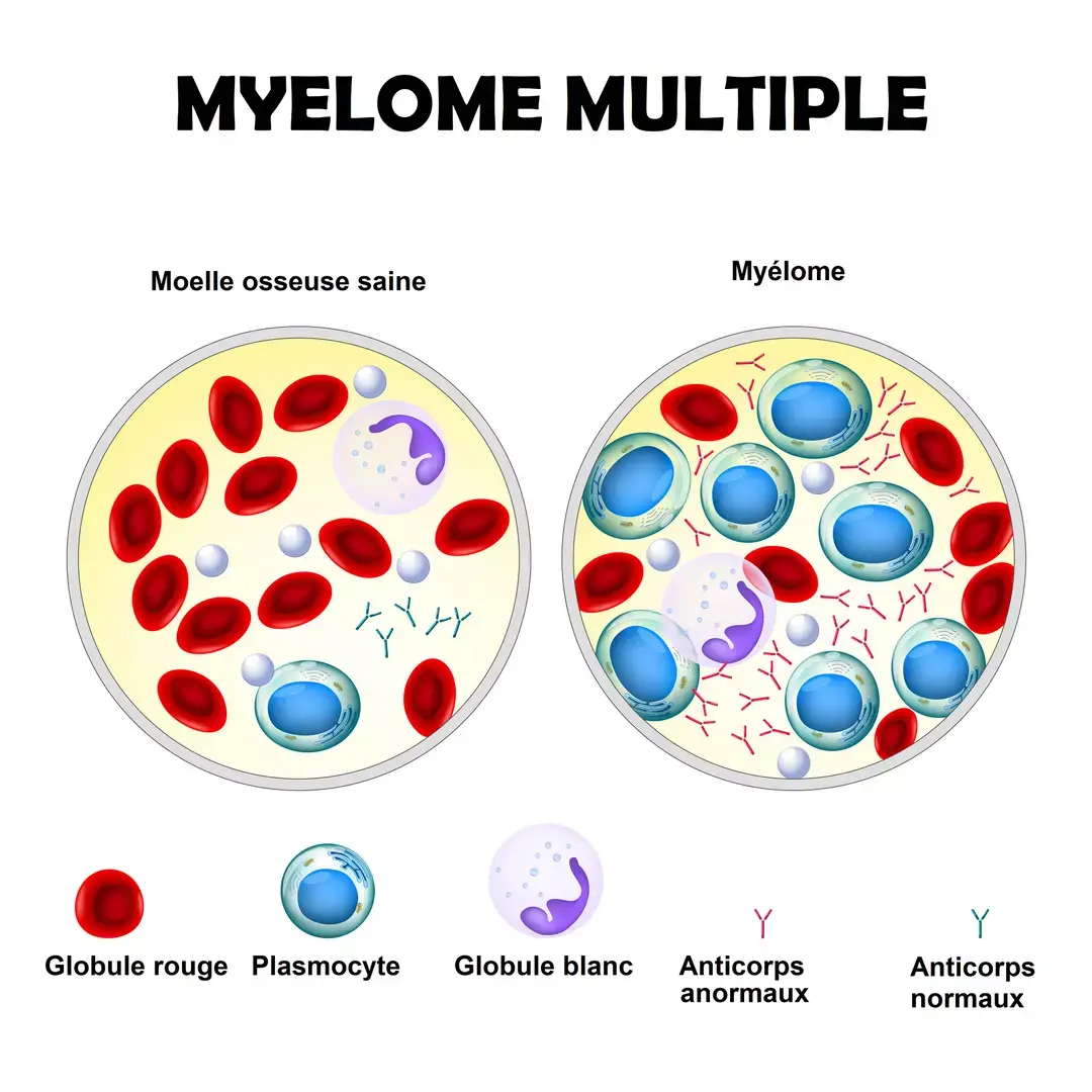 Myelome