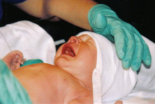 Newborn can naturally cure from hydrocele