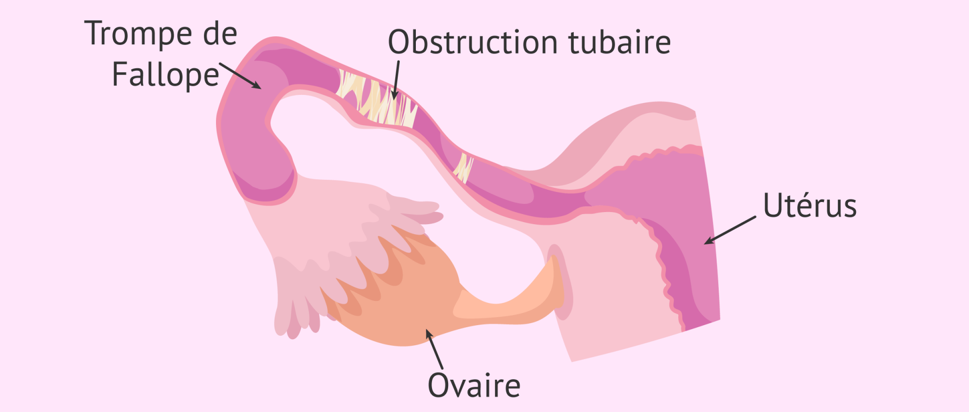 Obstruction des trompes