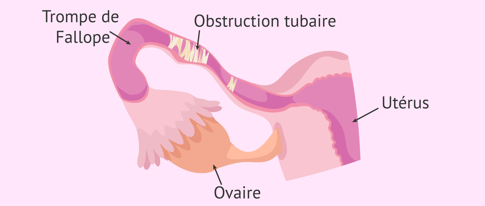 Obstruction tubaire