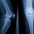 Osteomyelite