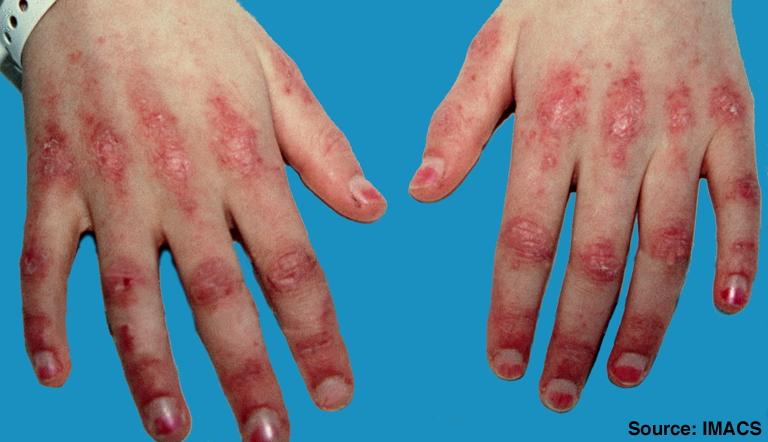 La dermatomyosite et le papules de Gottron: remède naturel