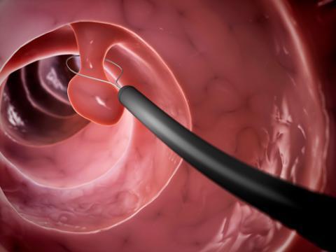 Nueva terapia natural para tratar los pólipos uterinos
