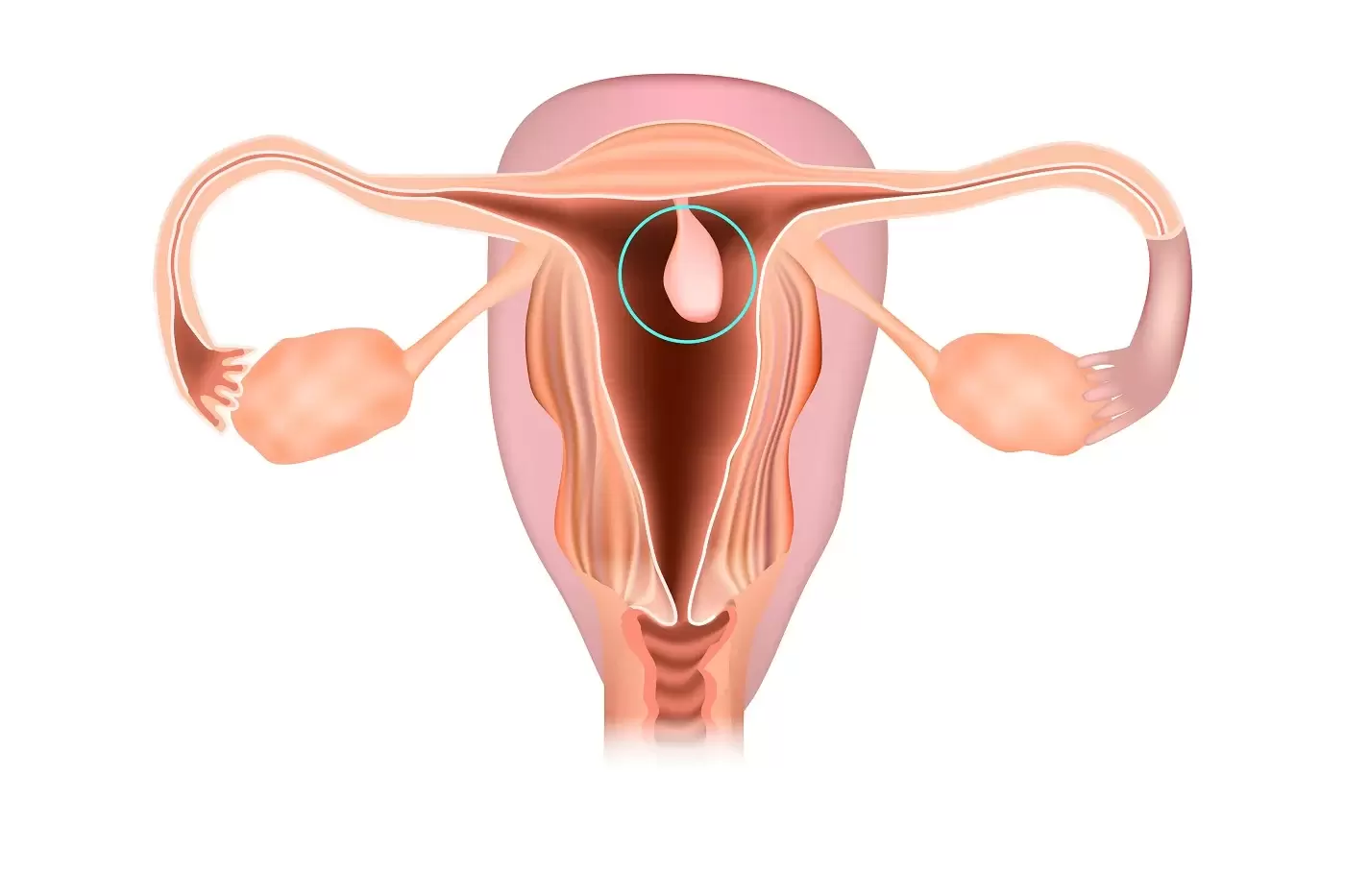 Polypes uterins 1