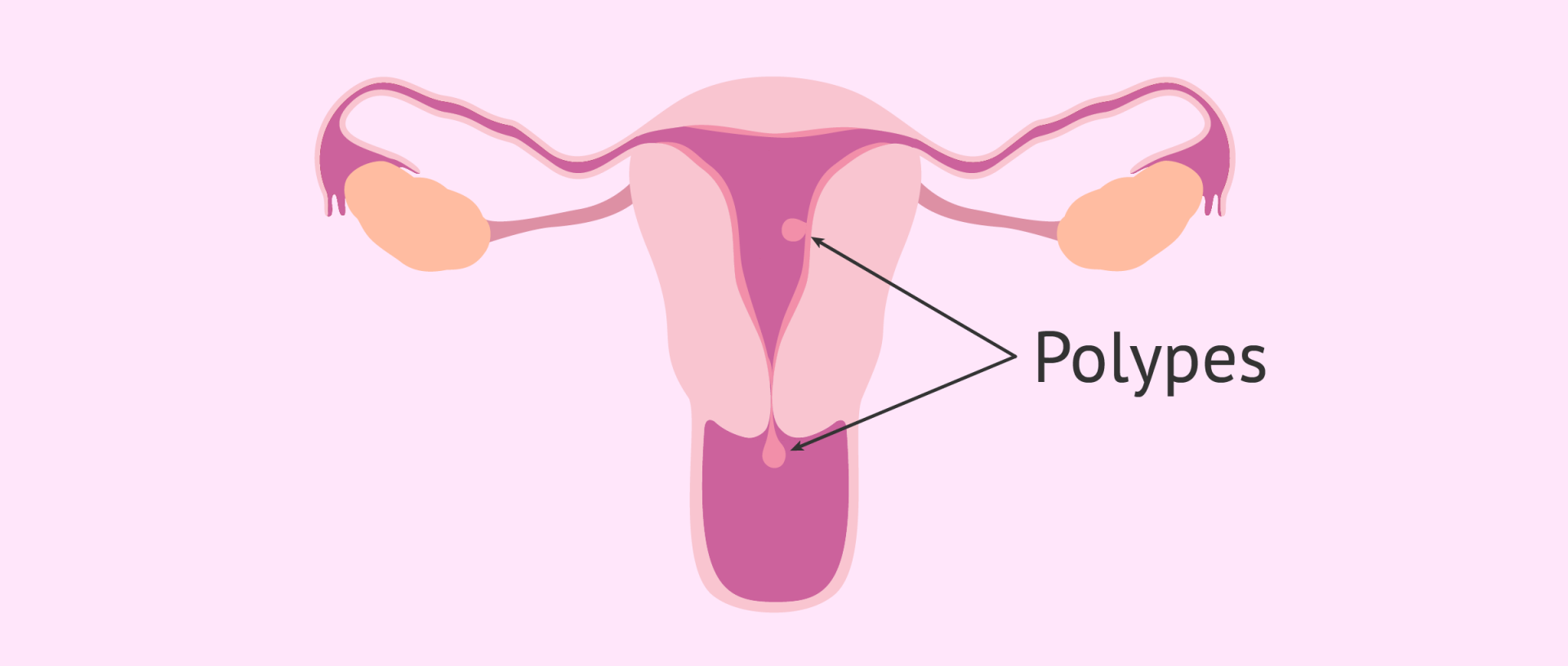 Polypes uterins