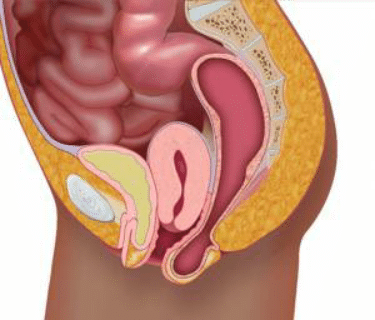 Prolapsus genital solution plantes