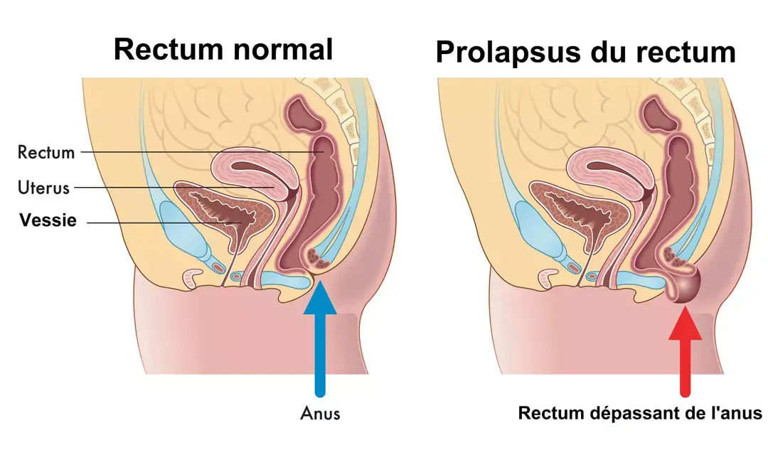 Prolapsus rectal 1