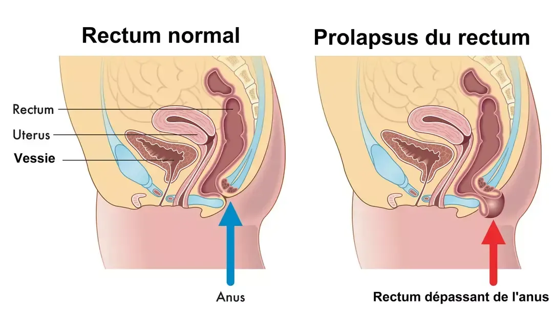 Plantes et remèdes naturels pour soigner le prolapsus rectal