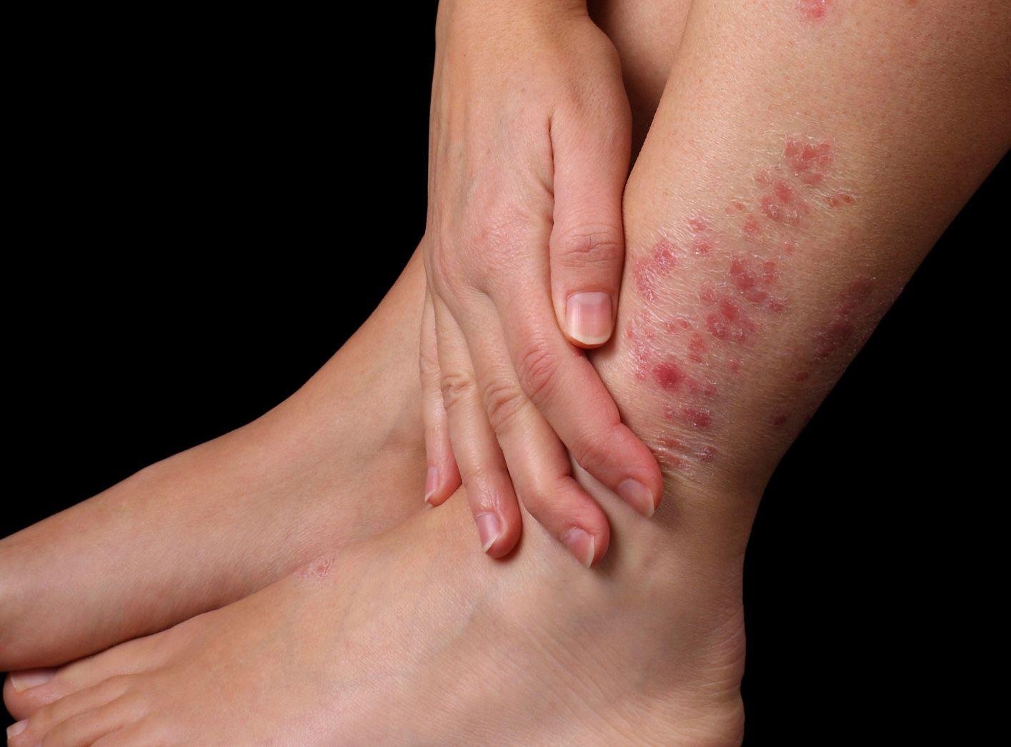 Plantes contre le psoriasis