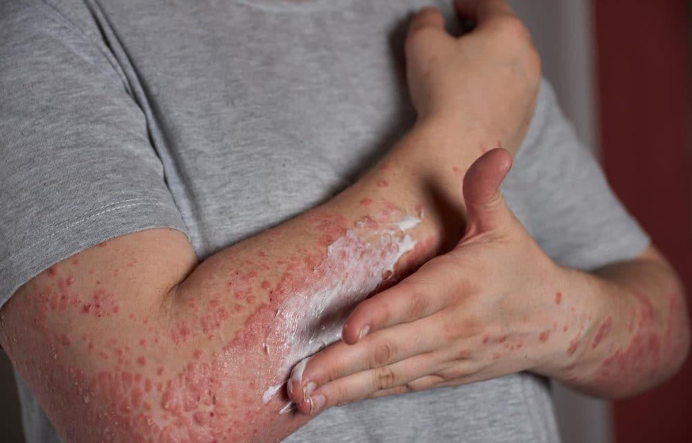 Psoriasis