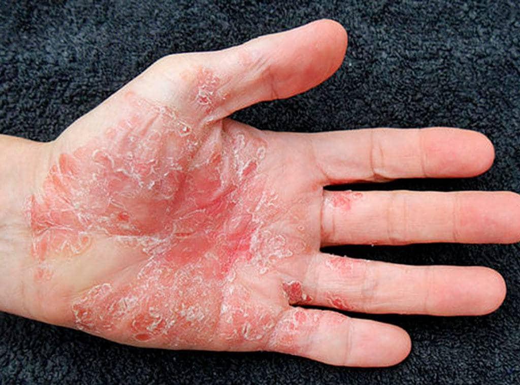 Psoriasis