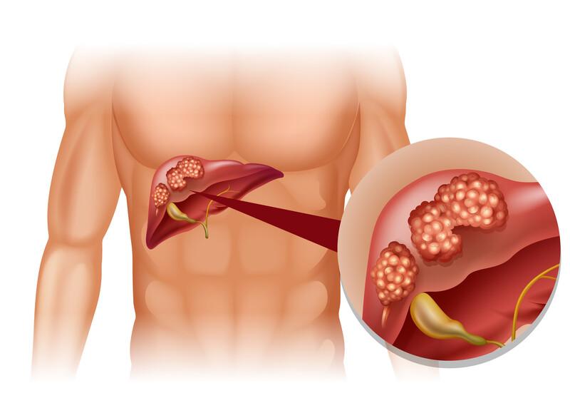 Réduire l'inflammation