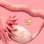 Salpingite et infertilite feminine traitements