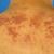 Sarcoidose1