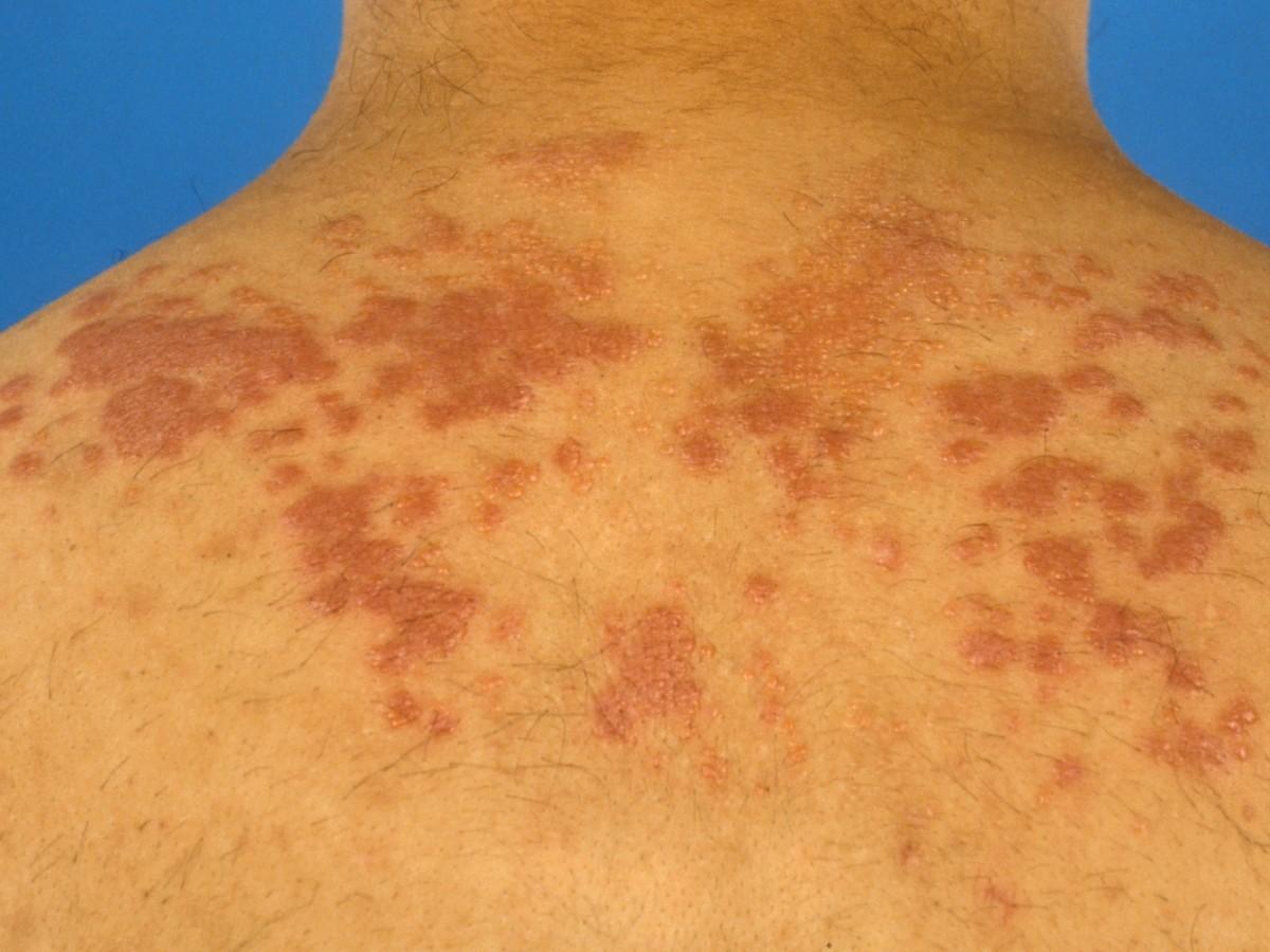 Sarcoïdose : Remèdes Naturels,  Causes et Symptômes