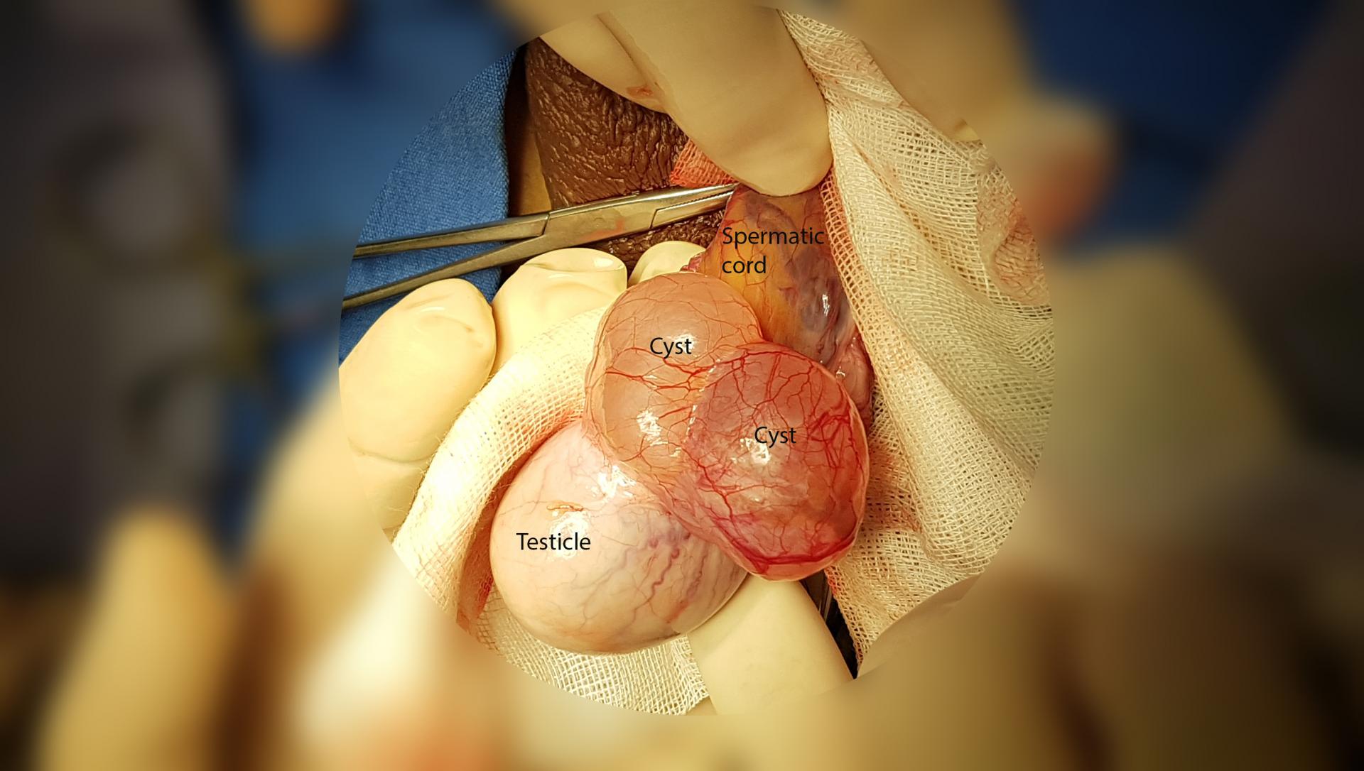 Shrink epididymal cyst naturally 1