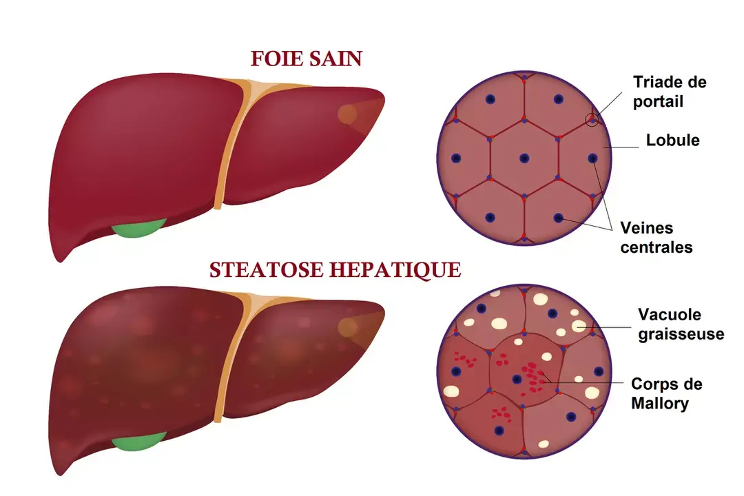 Steatose hepatique