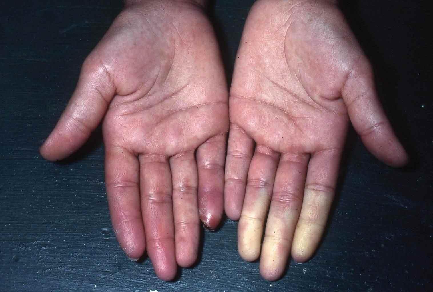 Syndrome de raynaud