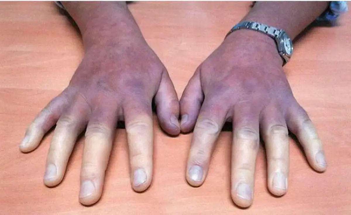 Syndrome de raynaud