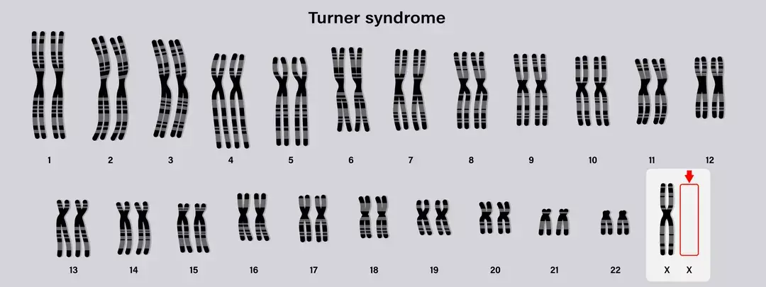 Syndrome de turner