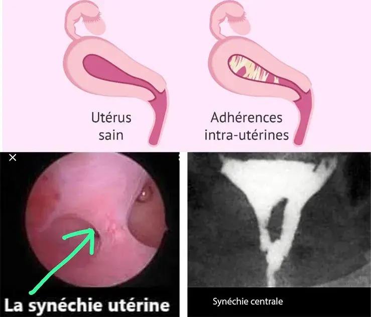 Synechie uterine