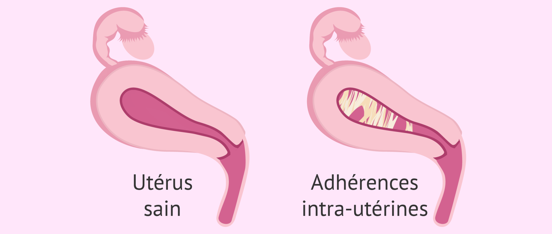 Synechies uterines