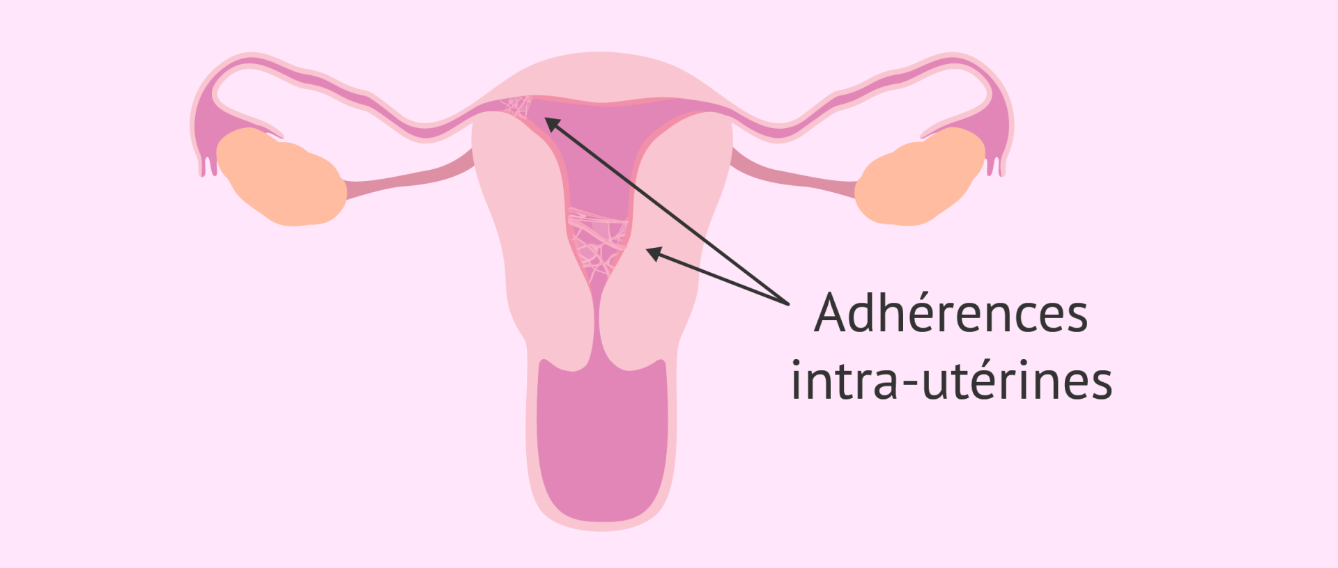 Synechies uterines1