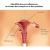 Sinequia uterina: causas, síntomas y remedios naturales