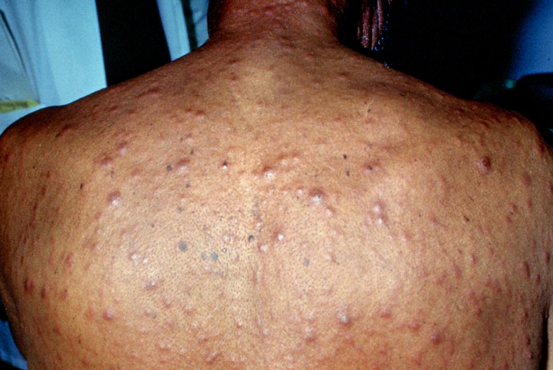 Plantes Contre La Syphilis