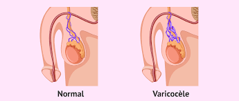 VARICOCELE ET FERTILITE: GUERISON NATURELLE