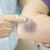 Thrombopenie saignement cutanee 