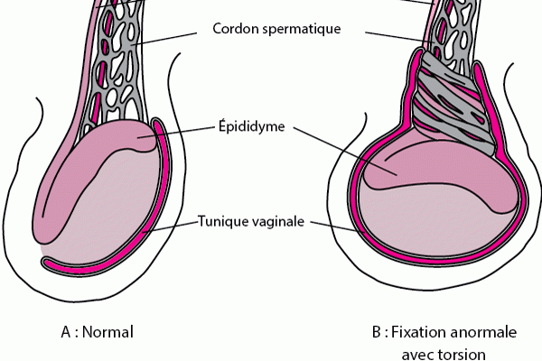 Torsion testiculaire