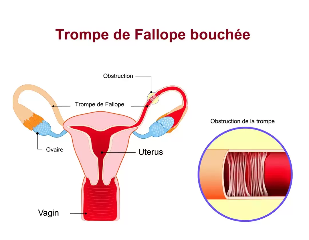 Trompe de fallope bouchee