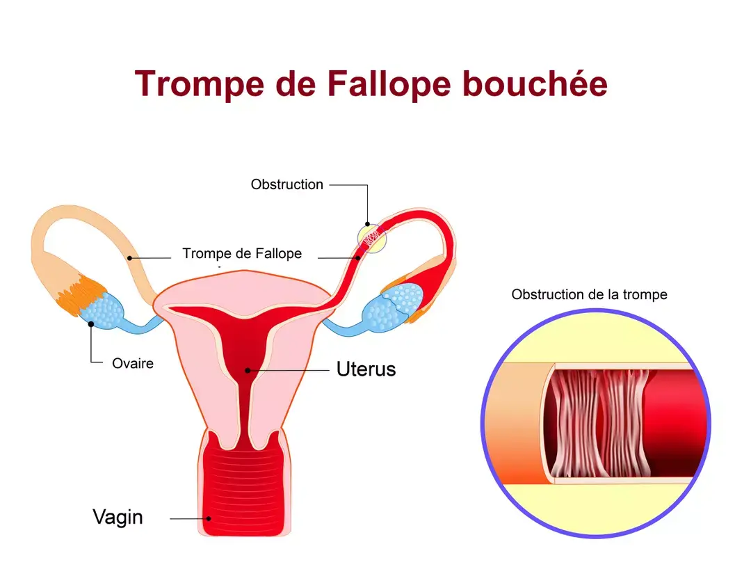 Trompes de fallope bouchees1