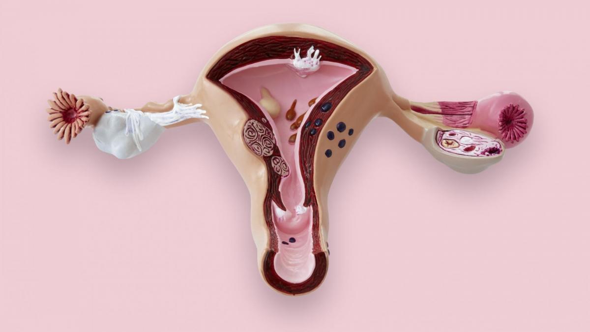 Comment utiliser l'argile contre les fibromes
