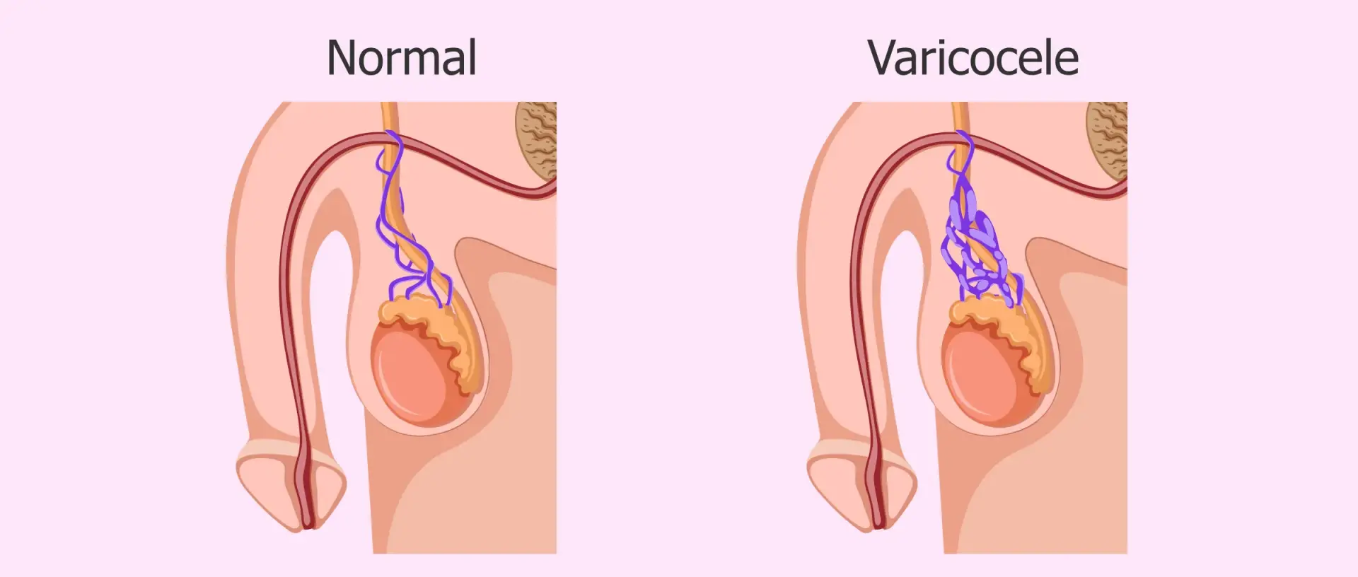 Varicocele 2