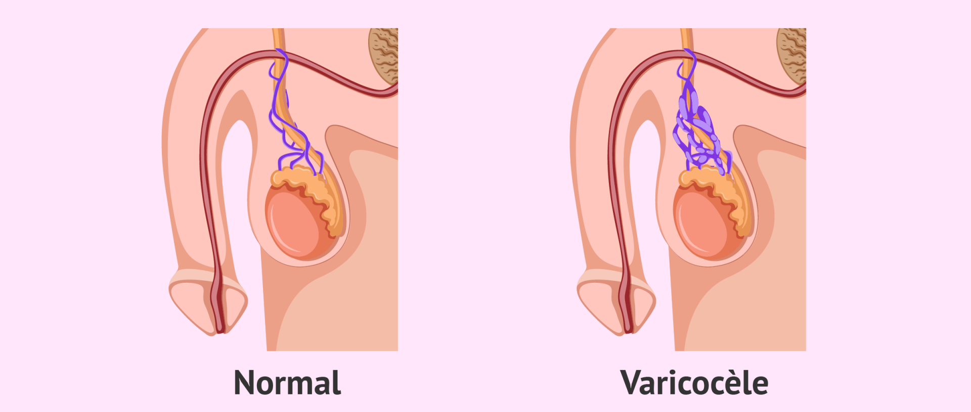 Varicocele 3