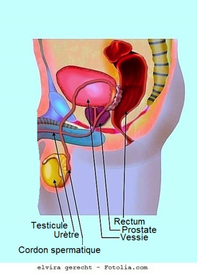 Varicocele photo